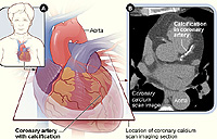 Coronary Calcium. From the National Heart Lung and Blood Institute, National Institutes of Health. 