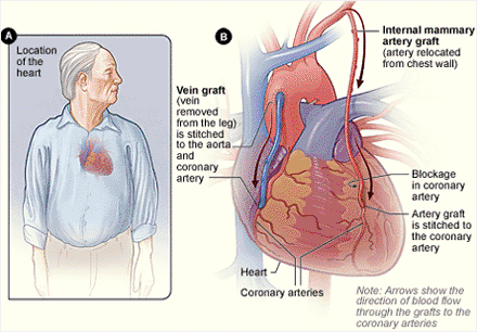 Figure:Coronary Artery Bypass Grafting. Figure A shows the location of the heart. Figure B shows how vein and artery bypass grafts are attached to the heart. From the National Heart and Blood Institute. http://www.nhlbi.nih.gov/health/dci/Diseases/cabg/cabg_whatis.html