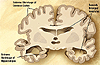 Combination of two brain diagrams in one for comparison. In the left normal brain, in the right brain of a person with Alzheimer's disease. Image from the Wikimedia Commons.