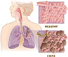 Image obtained from The National Heart, Lung, and Blood Institute (NHLBI) national campaign called COPD Learn More Breathe Better®."