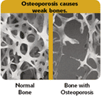 Surgeon General’s Report on Bone Health & Osteoporosis, from U.S. Department of Health and Human Services.