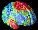 Mapping Brain Tissue Loss in Adolescents with Schizophrenia. This map reveals the 3-dimensional profile of gray matter loss in the brains of teenagers with early-onset schizophrenia, with a region of greatest loss in the temporal and frontal brain regions that control memory, hearing, motor functions, and attention. Using novel image analysis algorithms, dramatic reductions in the profiles of gray matter were detected, based on a database of 96 images from schizophrenic patients scanned repeatedly with MRI. The parallel extraction of anatomical models from all patients in the image database required 60 CPU hours, when running in parallel on an SGI RealityMonster with 32 internal CPUs. [Image by Paul Thompson, Christine Vidal, Judy Rapoport, and Arthur Toga].